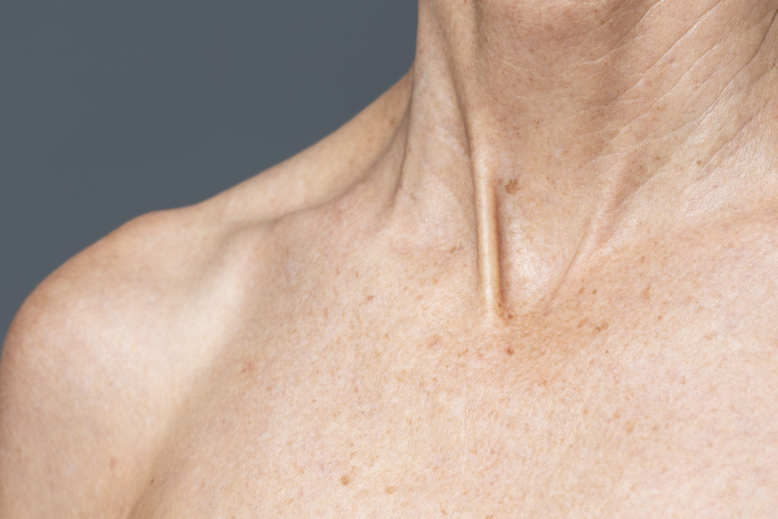 dermatitis atópica y dermatitis seborreica